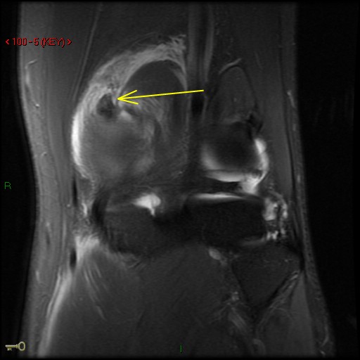 Figure 6 for case Medial head of gastrocnemius muscle ( RID2921 ) avulsion